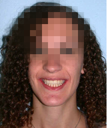 implantes dentales